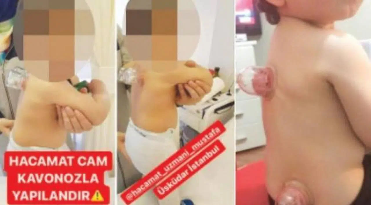 Bebeklere hacamat yapıyorlar!