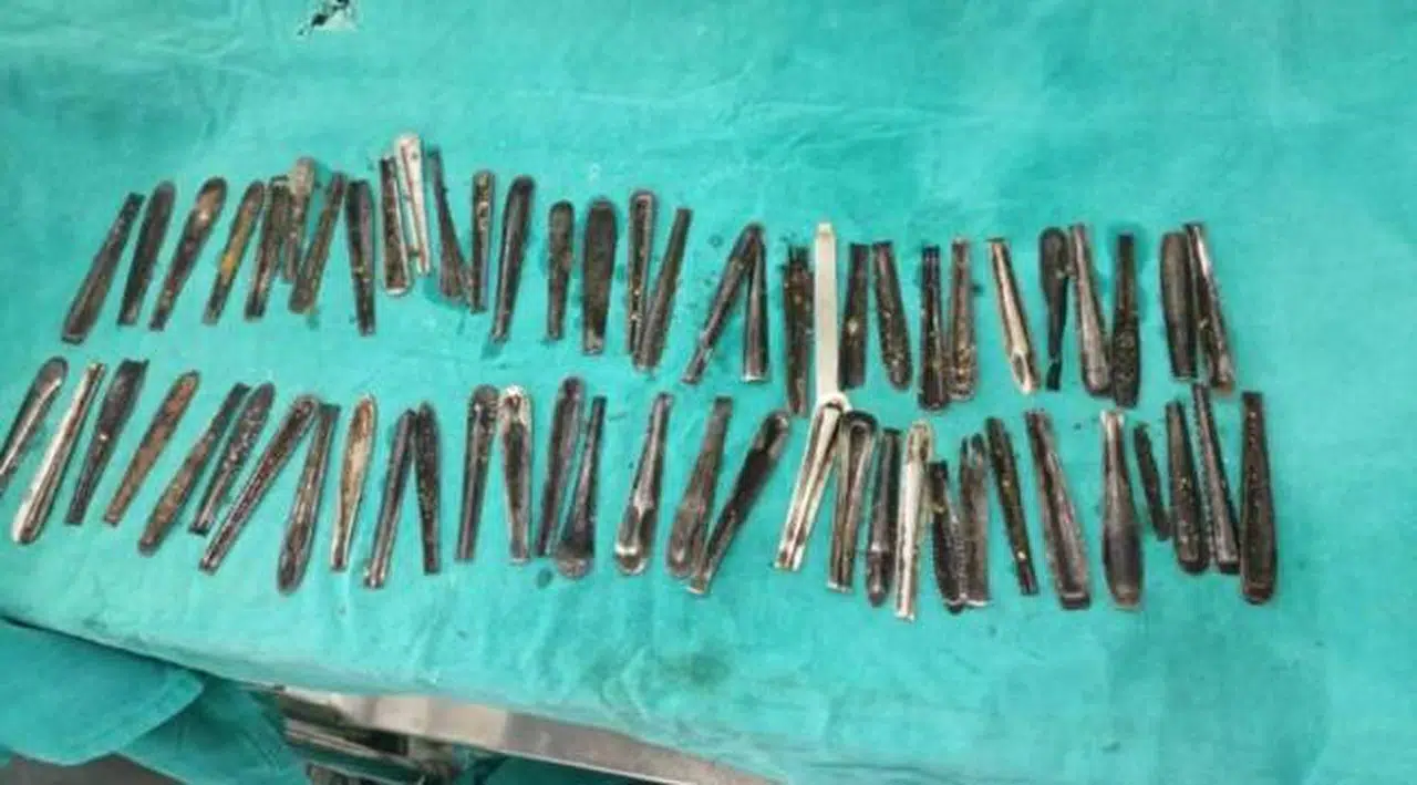 Karın ağrısı şikayetiyle hastaneye gitti, midesinden 60'tan fazla metal kaşık çıktı