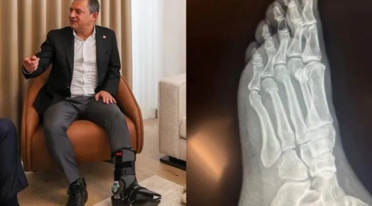 Özgür Özel, ayağının röntgen filmini paylaştı