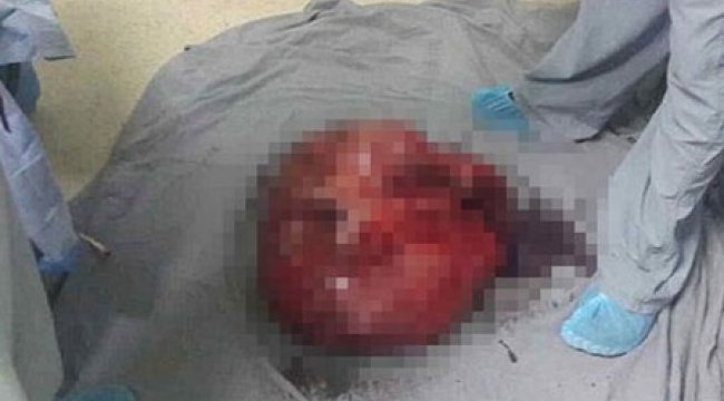 Hamile Sanılan Kadının Karnından Çıkan Şoke Etti