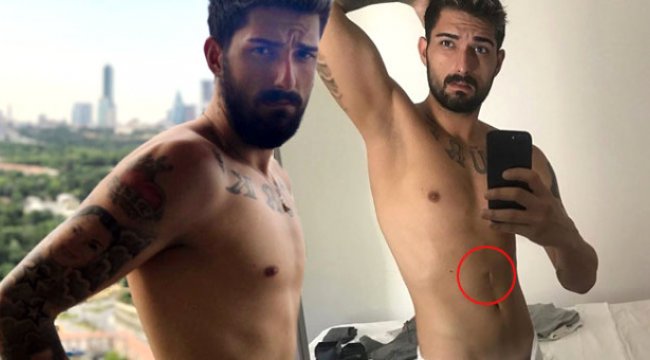 İdo'nun Midesindeki İzi Babası Açıkladı: Mide Borusu Doğuştan Tıkalıydı