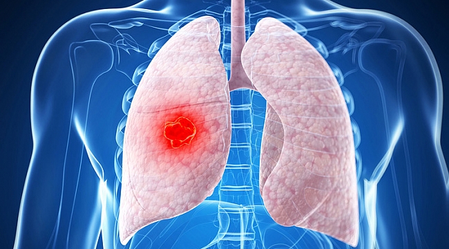 Zatürreyle Mücadele Güç Kazanıyor