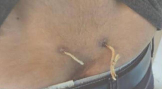 'Alternatif tıp'ta son nokta: Beline delik açıp çamaşır ipi geçirdiler