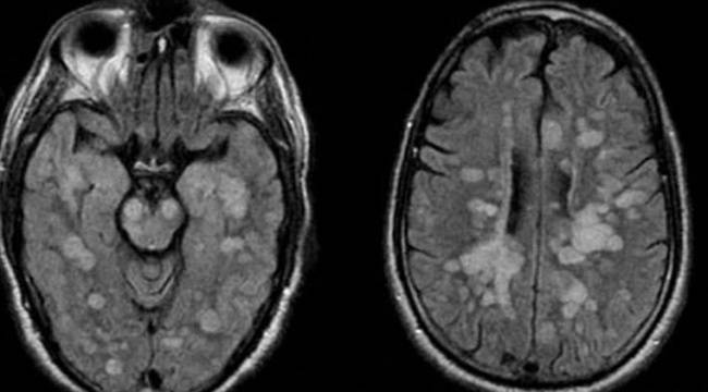 Koronavirüse yakalanan 8 yaşındaki çocuk felç oldu