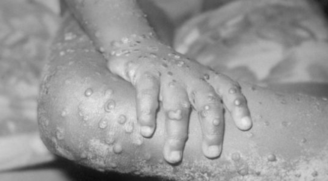 Küresel panik artıyor: Maymun çiçeği virüsü yayılıyor