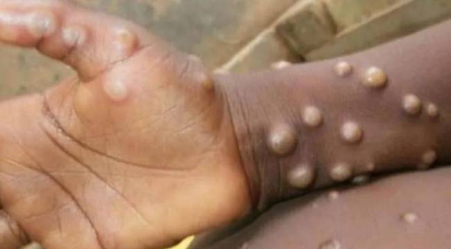 DSÖ: Maymun çiçeği virüsünden 3 kişi öldü