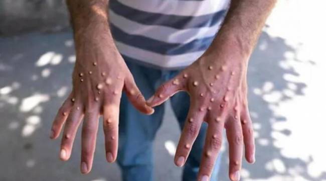 Avrupa'da maymun çiçeği vaka sayısı 20 bine dayandı