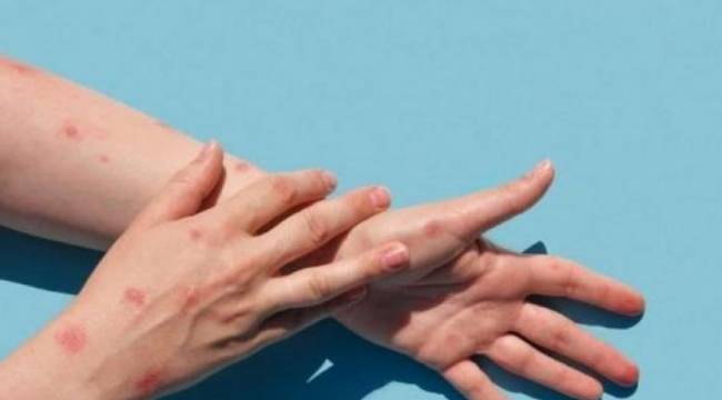 Sağlık Bakanlığı maymun çiçeği vaka sayısı açıkladı