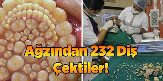 Ağzından 232 Diş Çekildi!