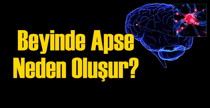 Beyinde Apse Belirtileri ve Tedavisi