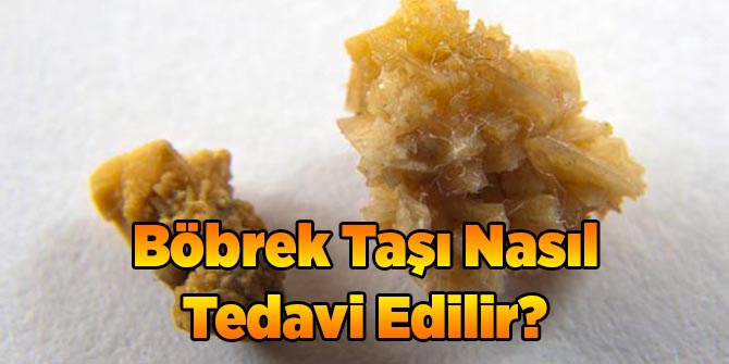 Böbrek Taşı Nasıl Tedavi Edilir?