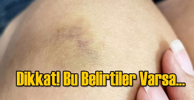 Bu Belirtiler Varsa Karaciğer Hastalığı Olabilir
