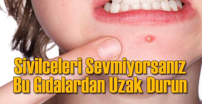 Bu Gıdalar Sivilce Çıkartıyor