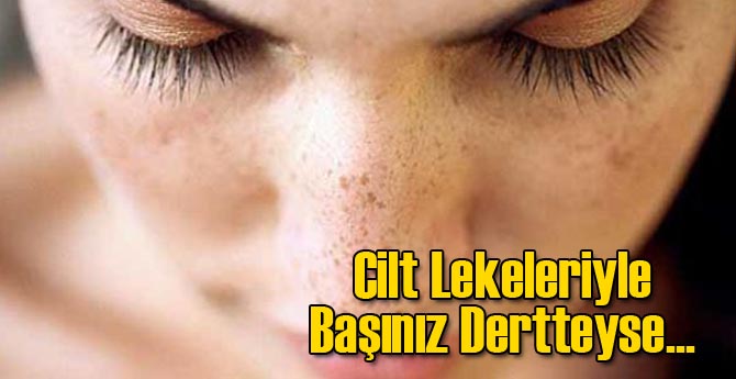 Cilt Lekeleriyle Başınız Dertteyse...
