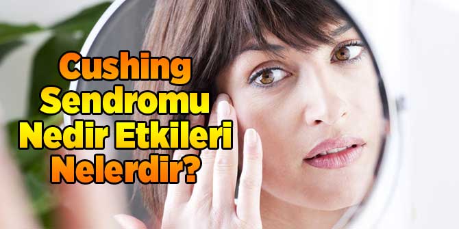 Cushing Sendromu Nedir Etkileri Nelerdir?