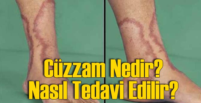Cüzzam Nedir? Tedavisi Nasıl Olur?
