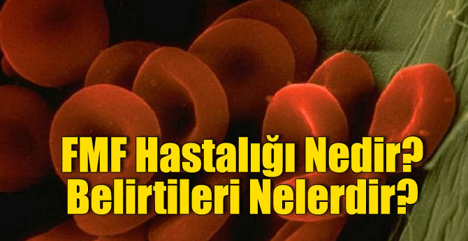 FMF Hastalığı Nedir? Belirtileri Nelerdir?