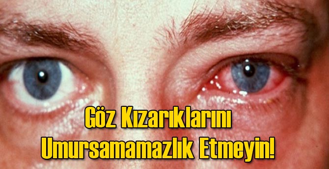Göz Kızarıklarını Umursamamazlık Etmeyin!