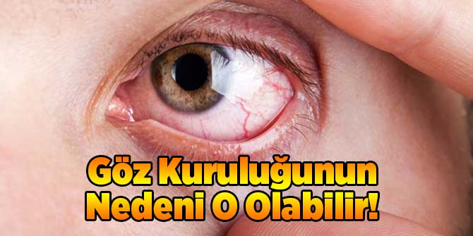 Göz Kuruluğunun Nedeni O Olabilir!