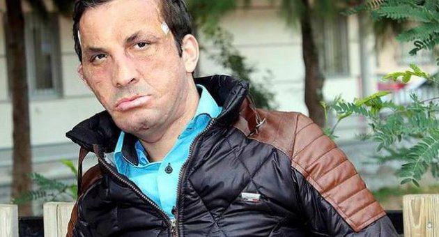 İlk yüz nakilli Uğur Acar'a, estetik müdahale