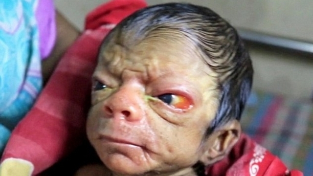 İşte Gerçek Benjamin Button!