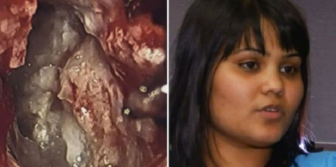 Kardeşini beyninde 26 yıl taşımış!