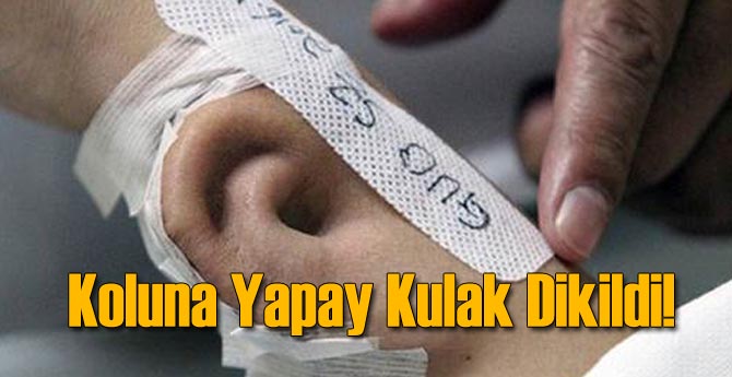 Kulağına Dikilen Yapay Kulak Duymasını Sağlayacak