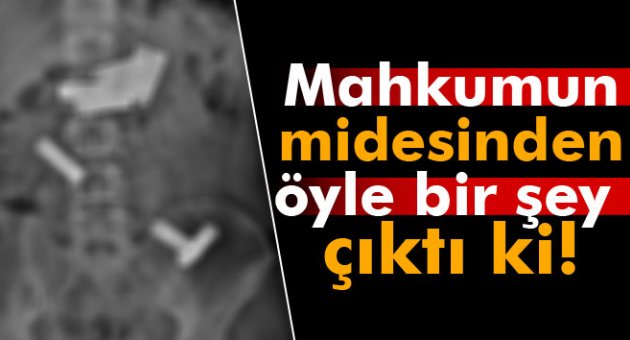 Mahkumun midesinden öyle bir şey çıktı ki!