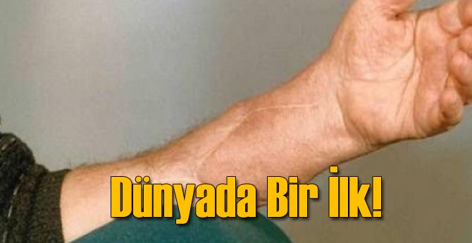 Ölen Hastanın Eli Başkasına Nakledildi