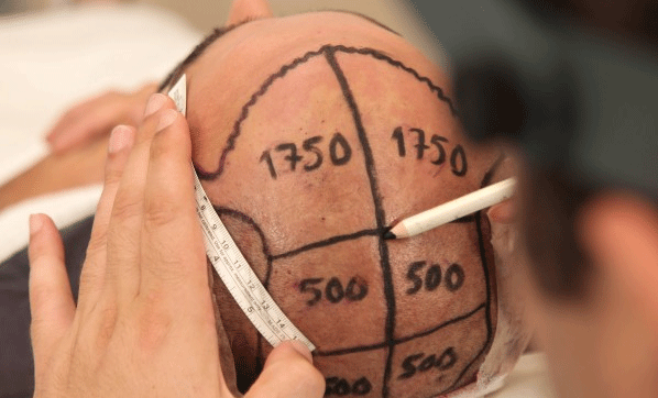 Saç ektirmeden önce bunu kesinlikle yapmayın