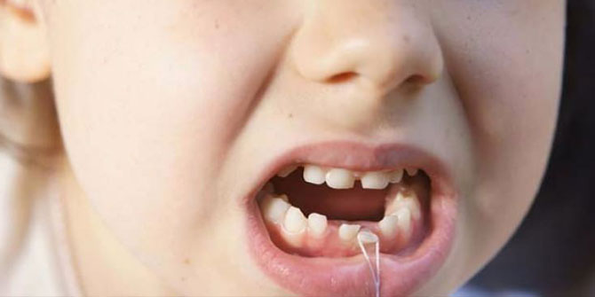 Şaka Gibi! Süt Dişlerini Atmayın Hayat Kurtarıyor!