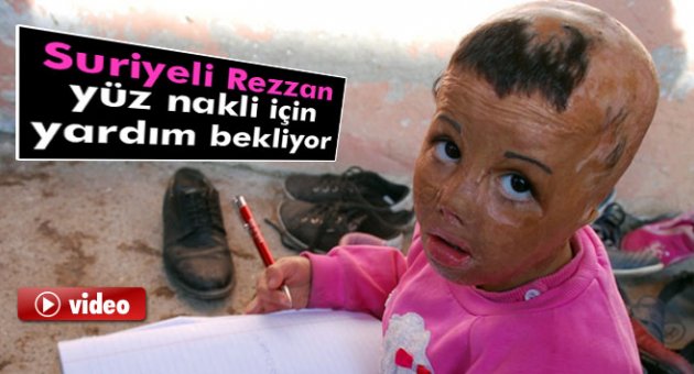 Suriyeli Rezzan yüz nakli için yardım bekliyor