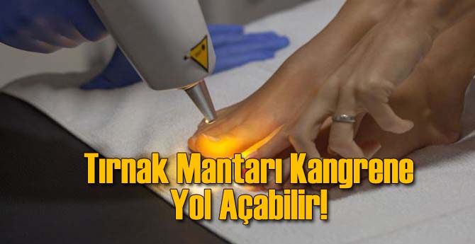 Tırnak Mantarı Ciddi Sağlık Problemlerine Yol Açabilir