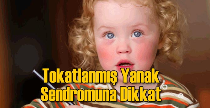 Tokatlanmış Yanak Sendromuna Dikkat!