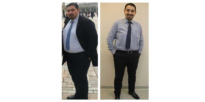 Tüp mide ameliyatıyla 1 yılda 60 kilo verdi