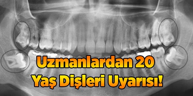 Uzmanlardan 20 Yaş Dişleri Uyarısı!