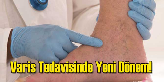 Varis Tedavisinde Yeni Dönem