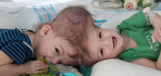 Yapışık İkizler Ameliyatla Ayırıldı