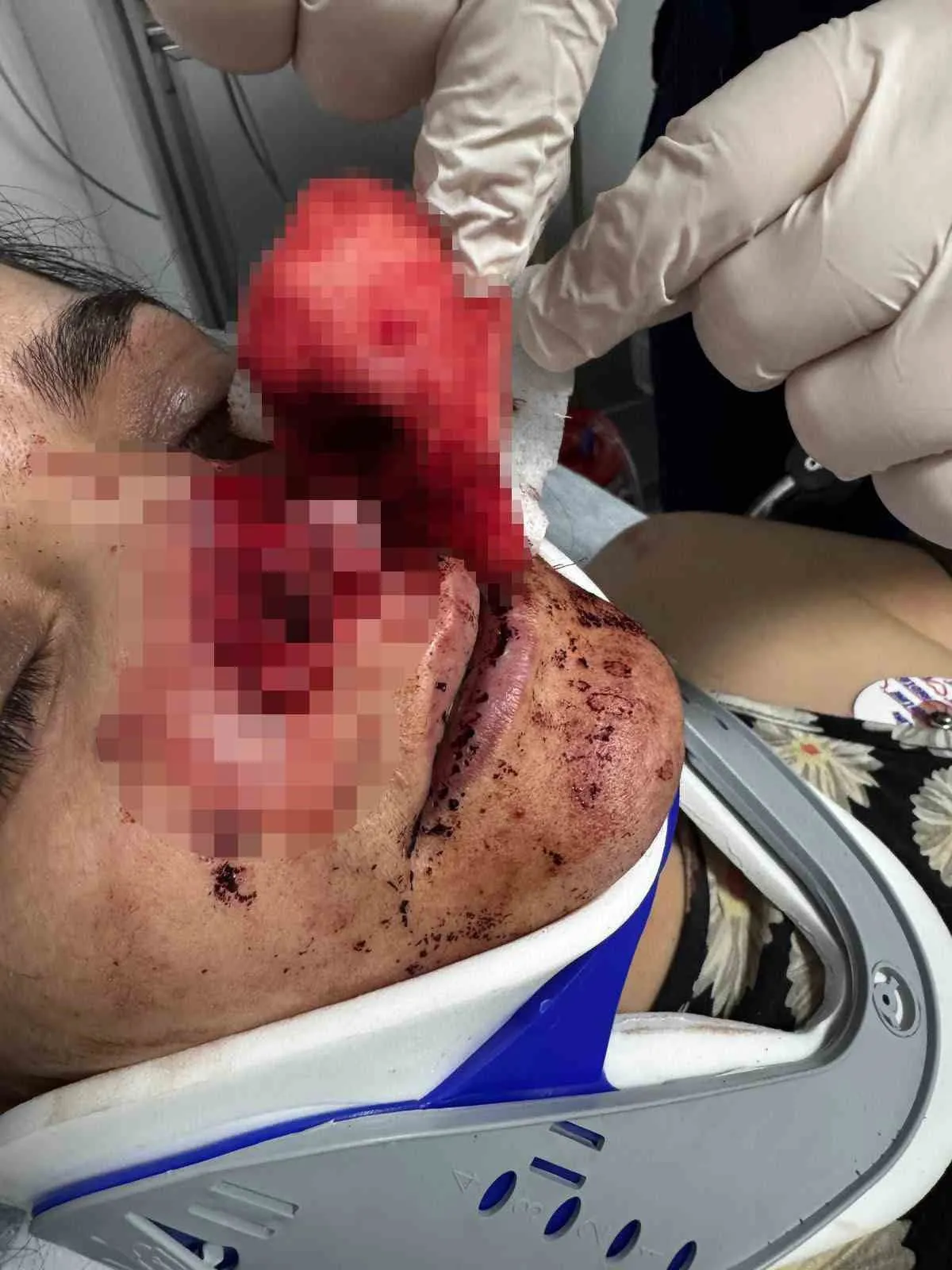 Turgutlu'da dehşet gecesi: Eşinin kopardığı burun cerrahi müdahaleyle kurtarıldı